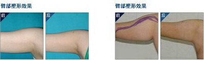 手臂吸脂多少毫升合适_手臂吸脂600毫升能瘦多少