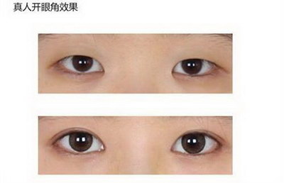 福州眼角除皱费用